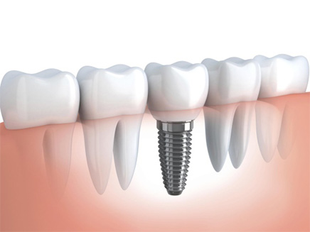 Cosmesi dentale